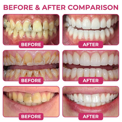 Natural Enamel-Filling Gel for Cavity Repair