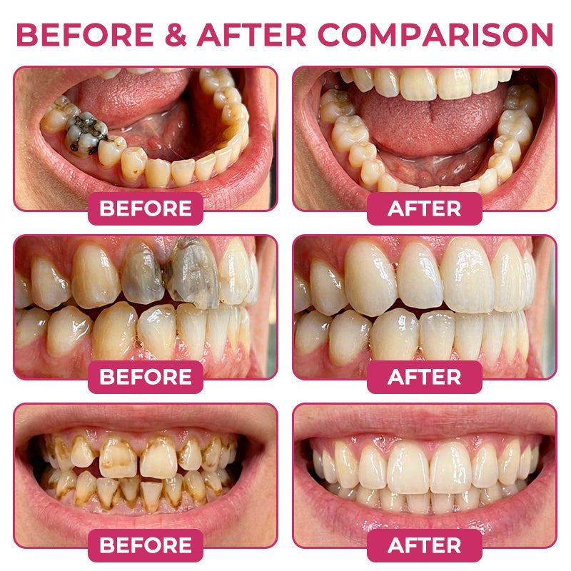 Natural Enamel-Filling Gel for Cavity Repair