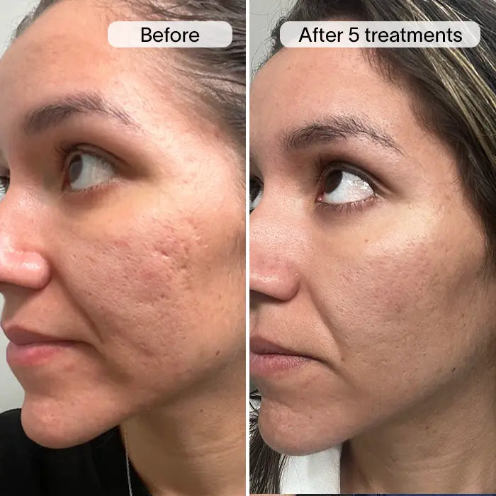 ReGenScar Stem Cell Scar Gel