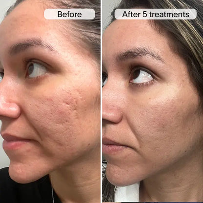 ReGenScar Stem Cell Scar Gel