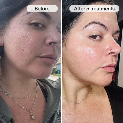 ReGenScar Stem Cell Scar Gel